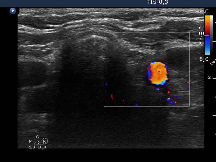 Right lobe, longitudinal scan