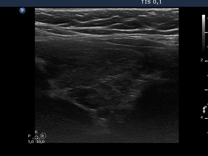 Right lobe, longitudinal scan