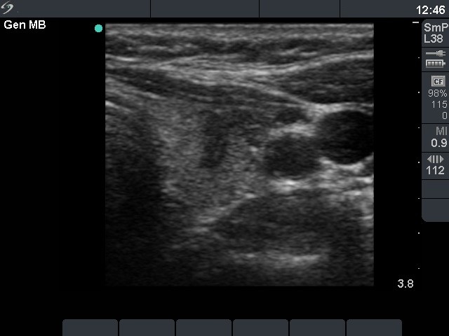 Right lobe, longitudinal scan