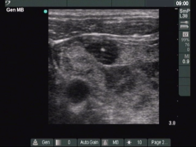 Right lobe, longitudinal scan
