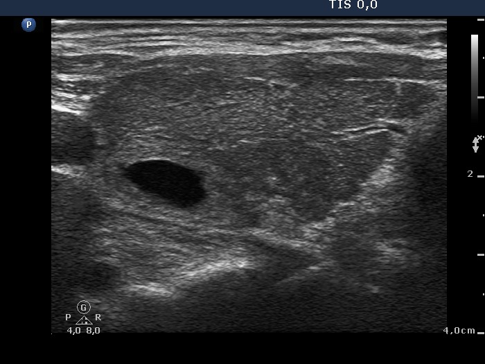 Right lobe, longitudinal scan