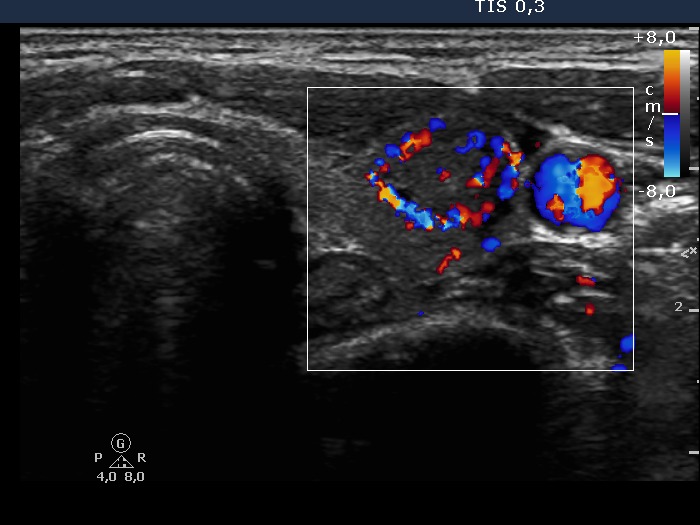 Right lobe, longitudinal scan