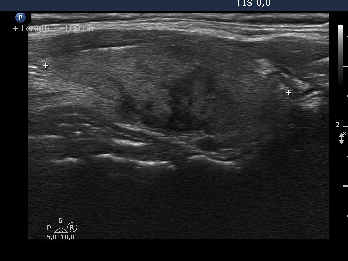 Right lobe, longitudinal scan