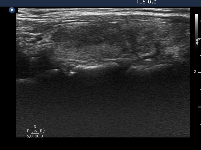 Right lobe, longitudinal scan