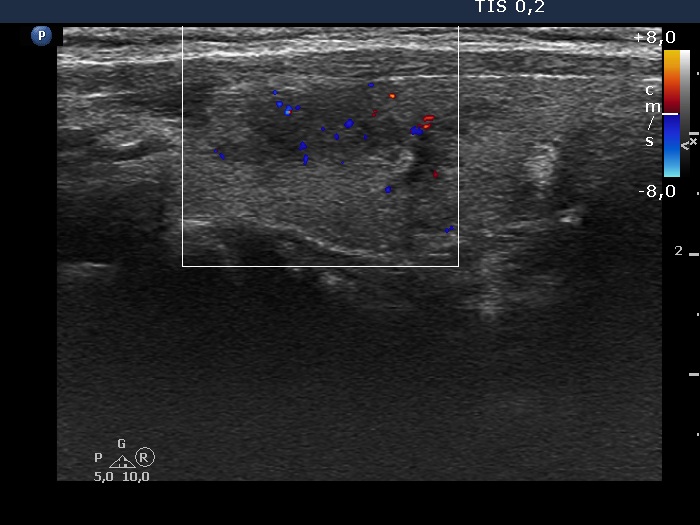 Right lobe, longitudinal scan