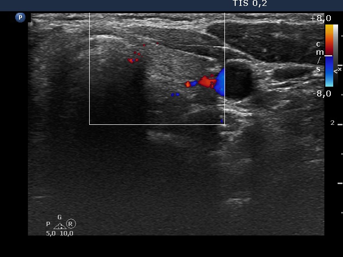 Right lobe, longitudinal scan