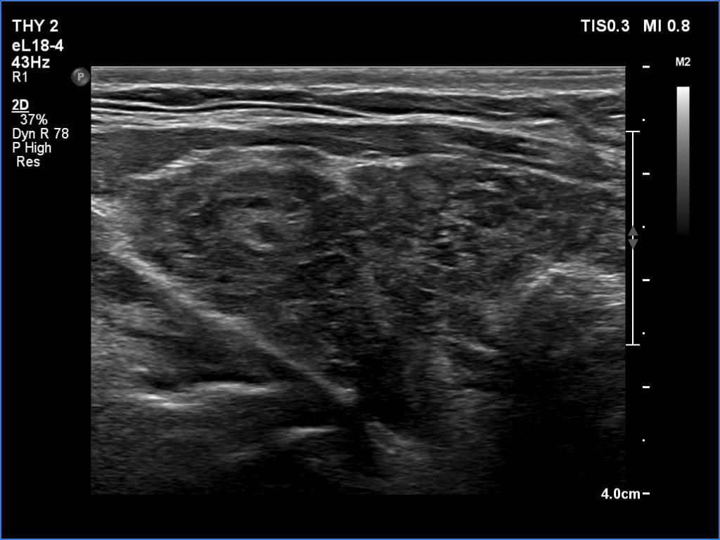 Right lobe, longitudinal scan