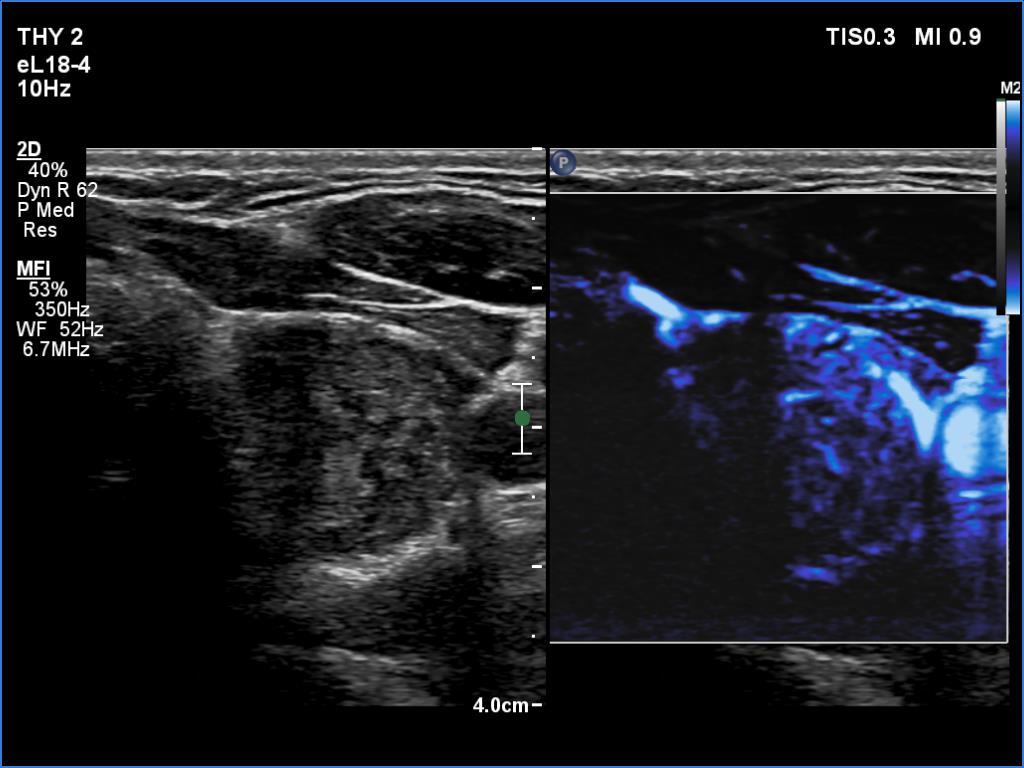 Right lobe, longitudinal scan