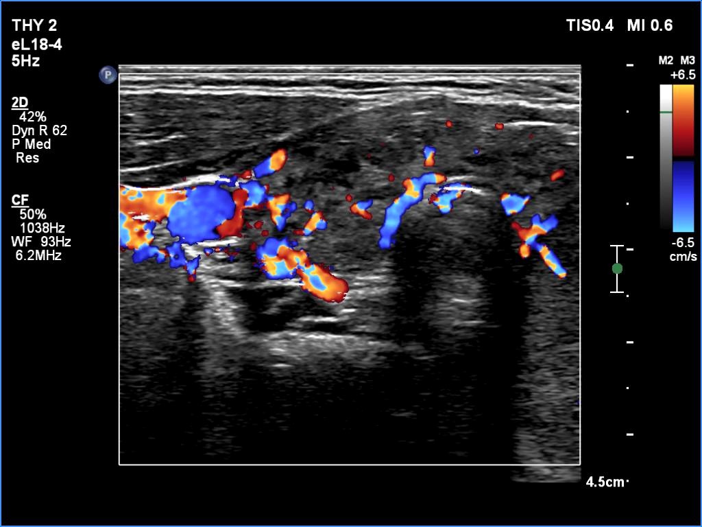 Right lobe, longitudinal scan