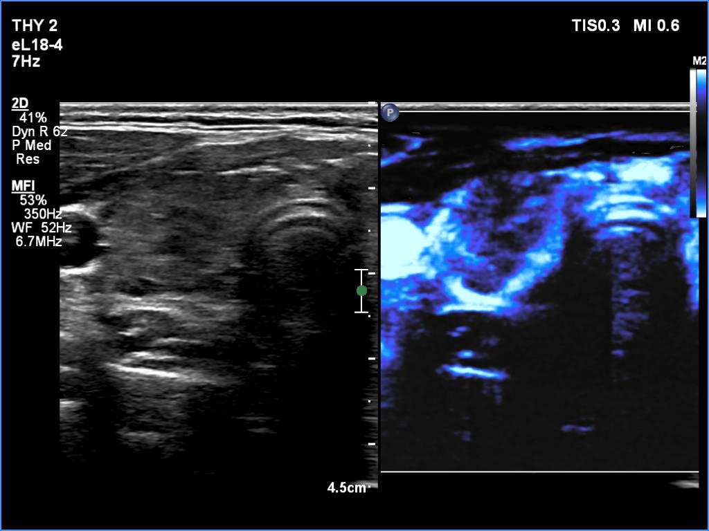 Right lobe, longitudinal scan
