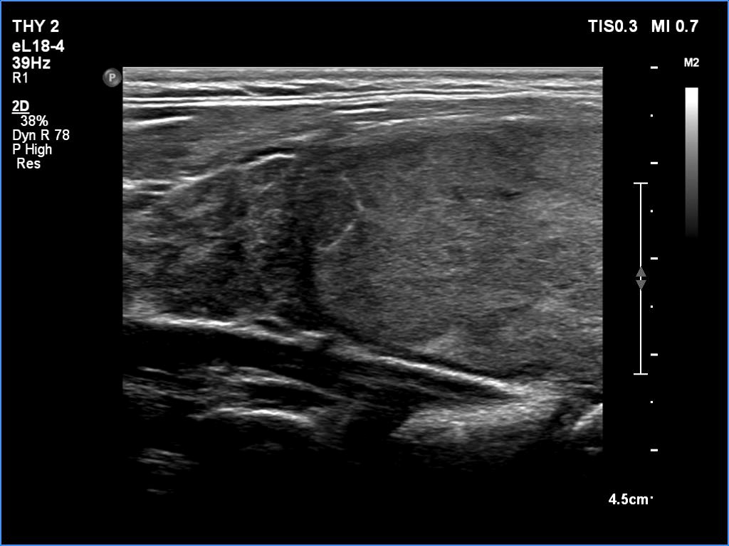 Right lobe, longitudinal scan