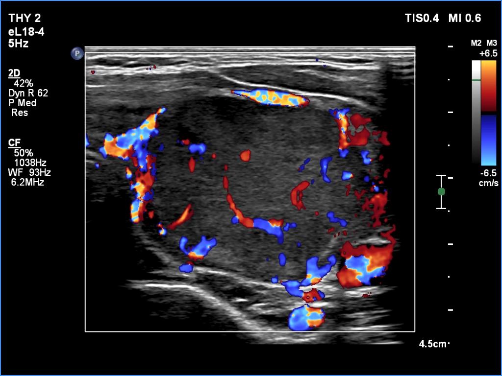 Right lobe, longitudinal scan