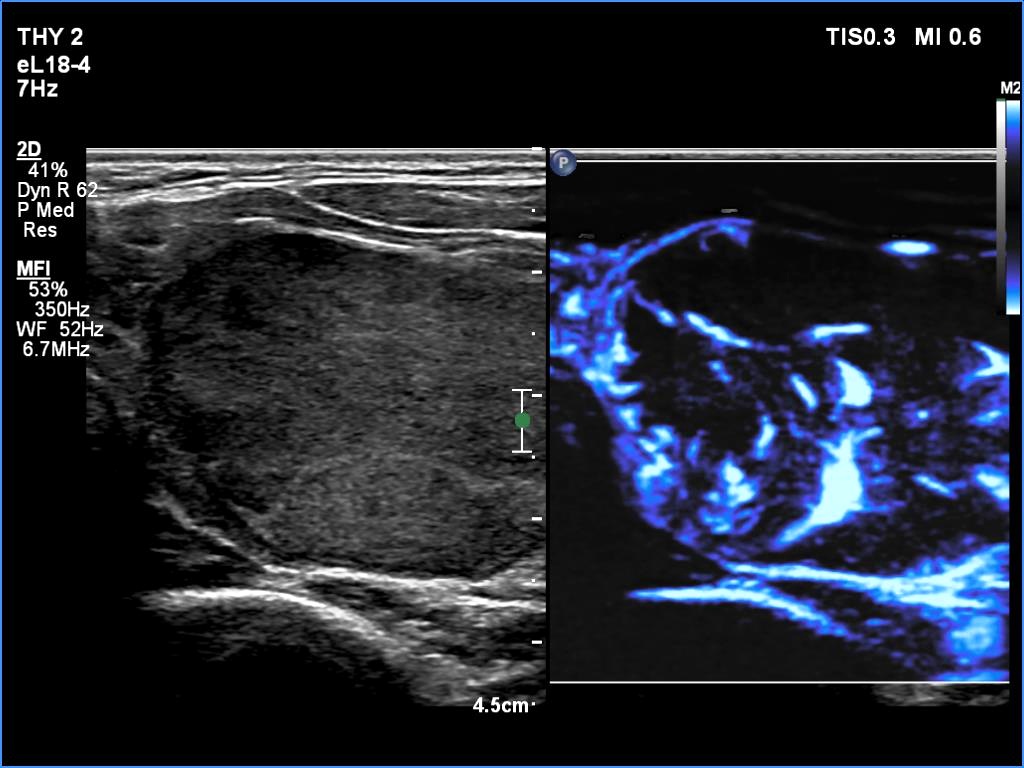 Right lobe, longitudinal scan