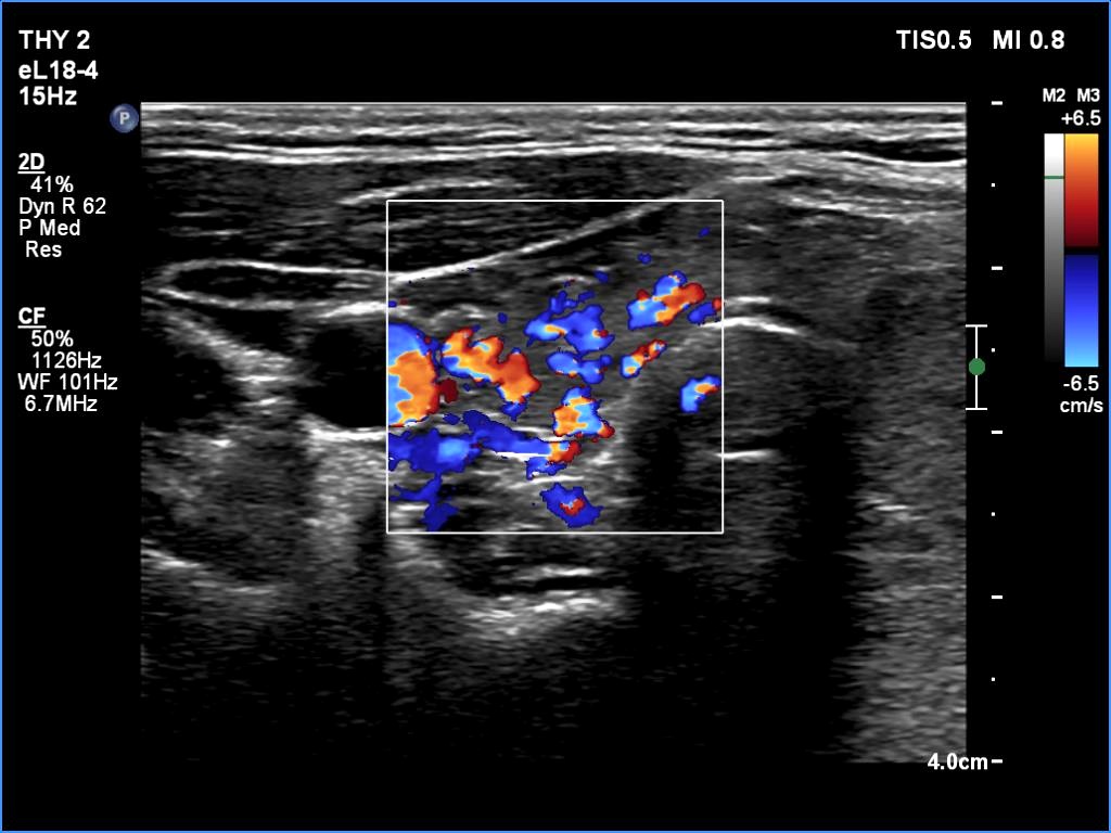 Right lobe, longitudinal scan