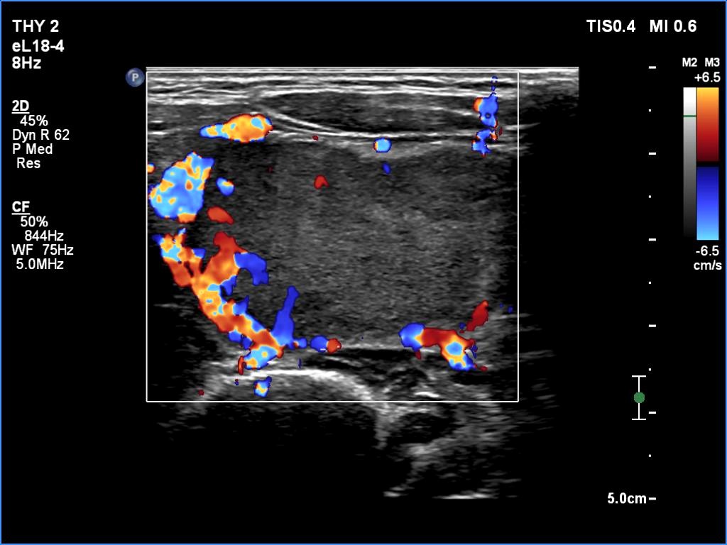Right lobe, longitudinal scan