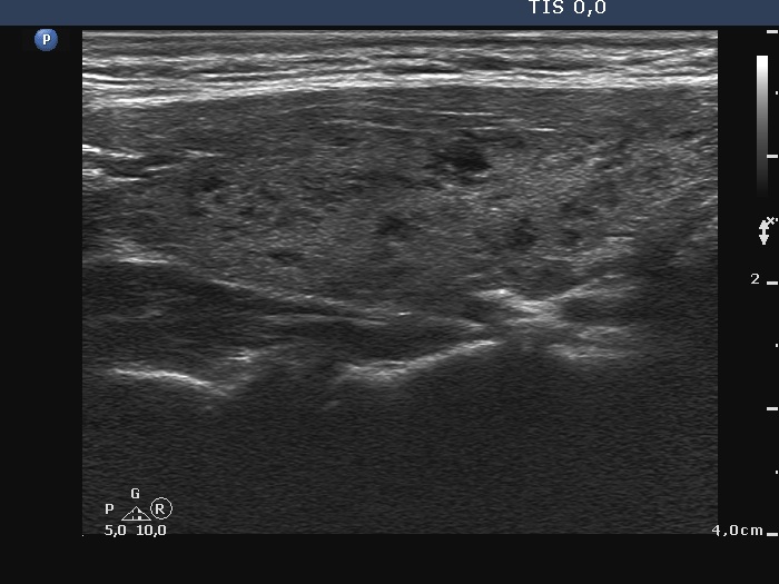 Right lobe, longitudinal scan