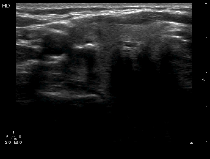 Right lobe, horizontal view