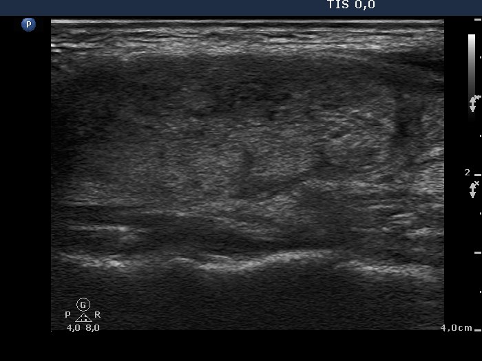 Right lobe, longitudinal scan