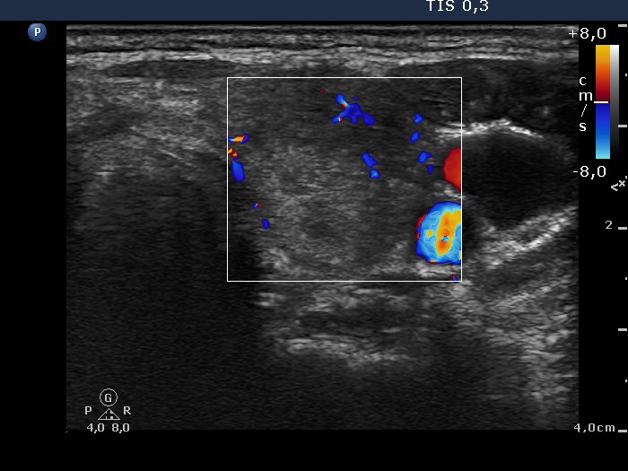 Right lobe, longitudinal scan