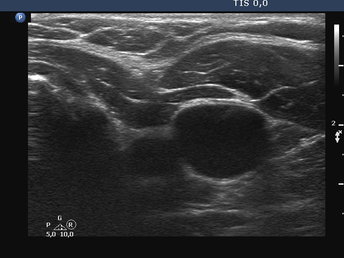Right lobe, longitudinal scan