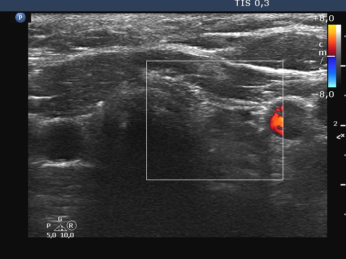 Right lobe, longitudinal scan