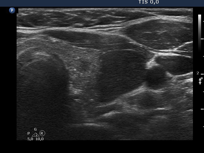 Right lobe, longitudinal scan