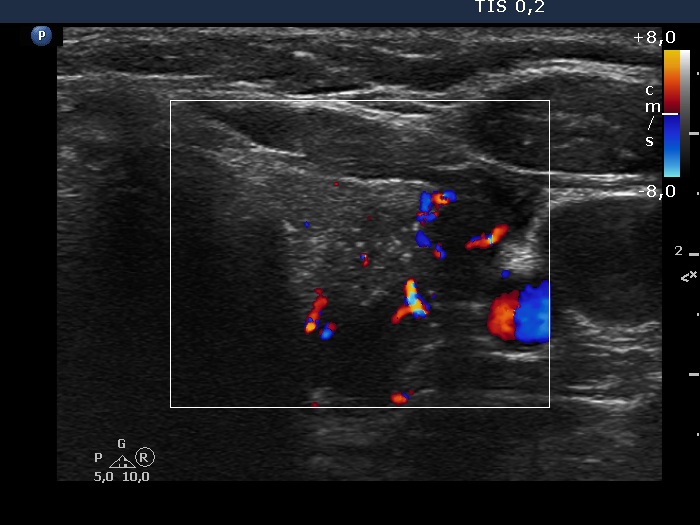 Right lobe, longitudinal scan