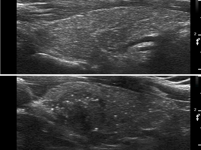 Right lobe, longitudinal scan