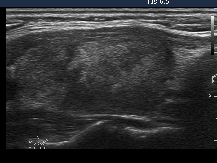 Right lobe, longitudinal scan