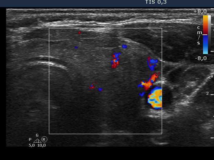 Right lobe, longitudinal scan