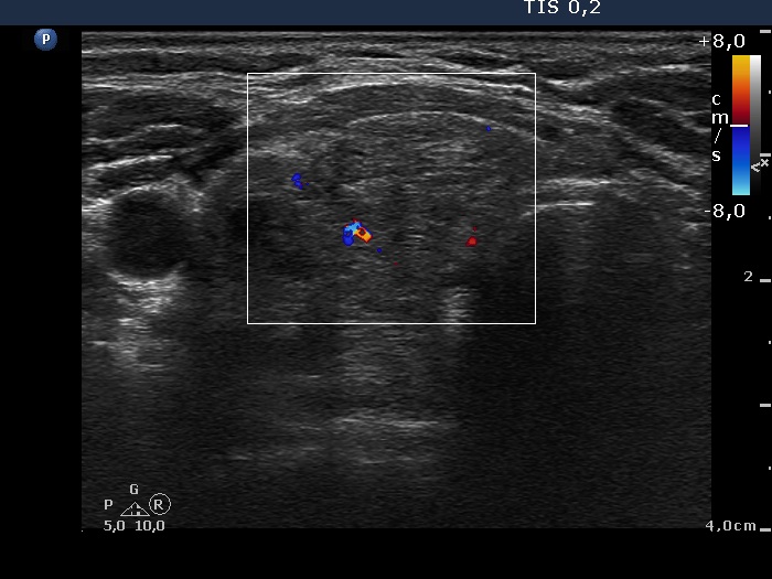 Right lobe, longitudinal scan