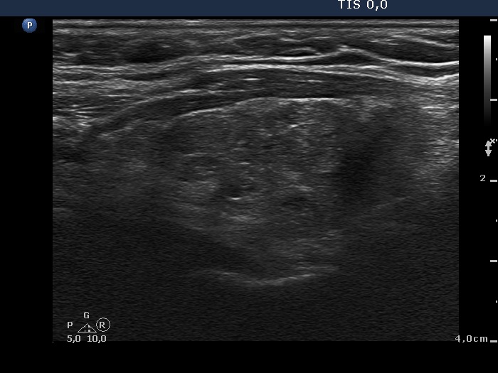 Right lobe, longitudinal scan