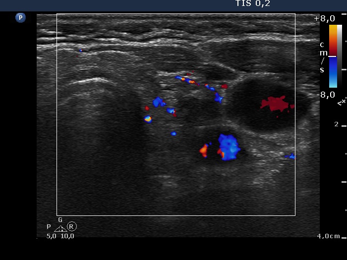 Right lobe, longitudinal scan
