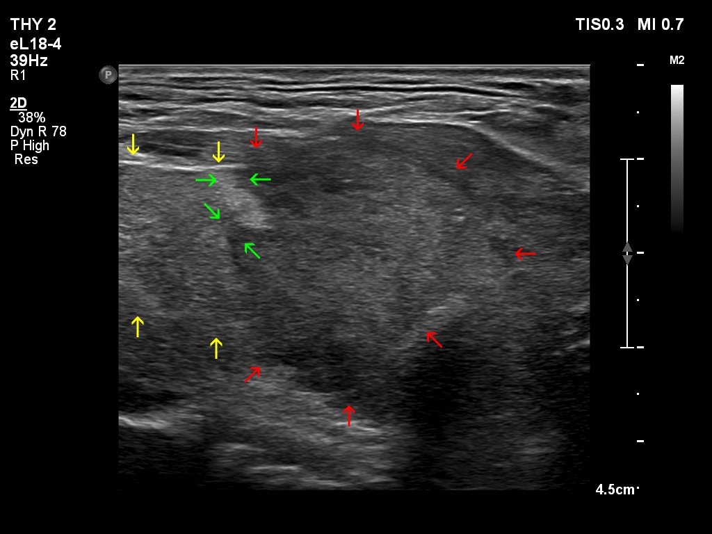 Right lobe, longitudinal scan