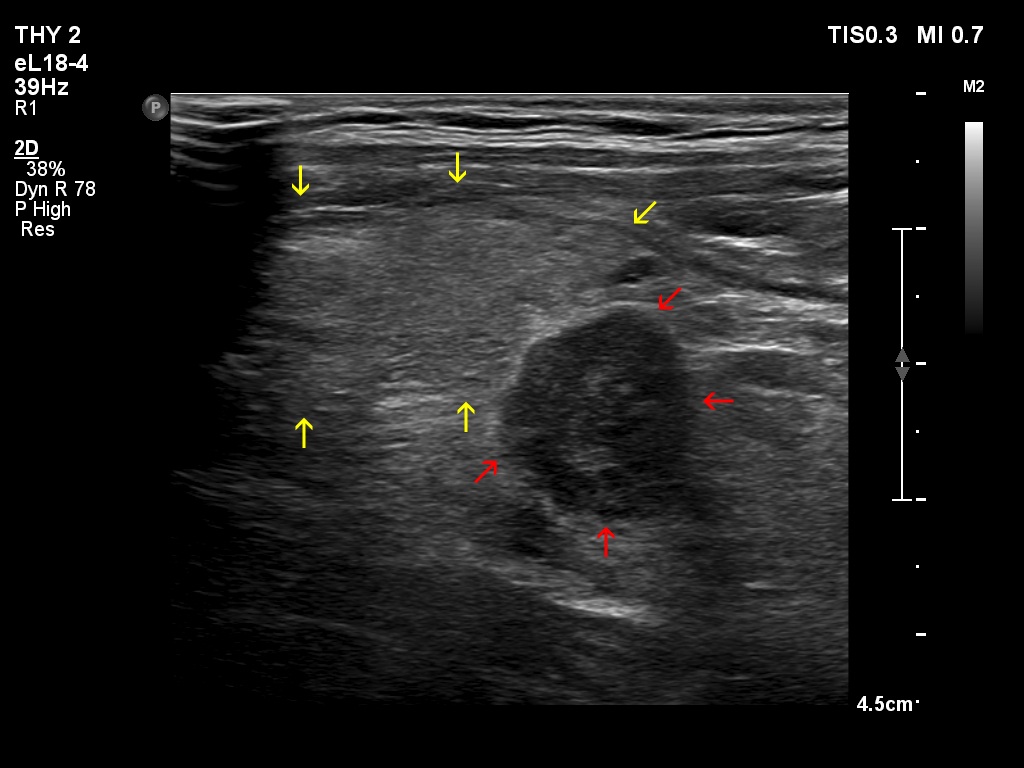 Right lobe, longitudinal scan
