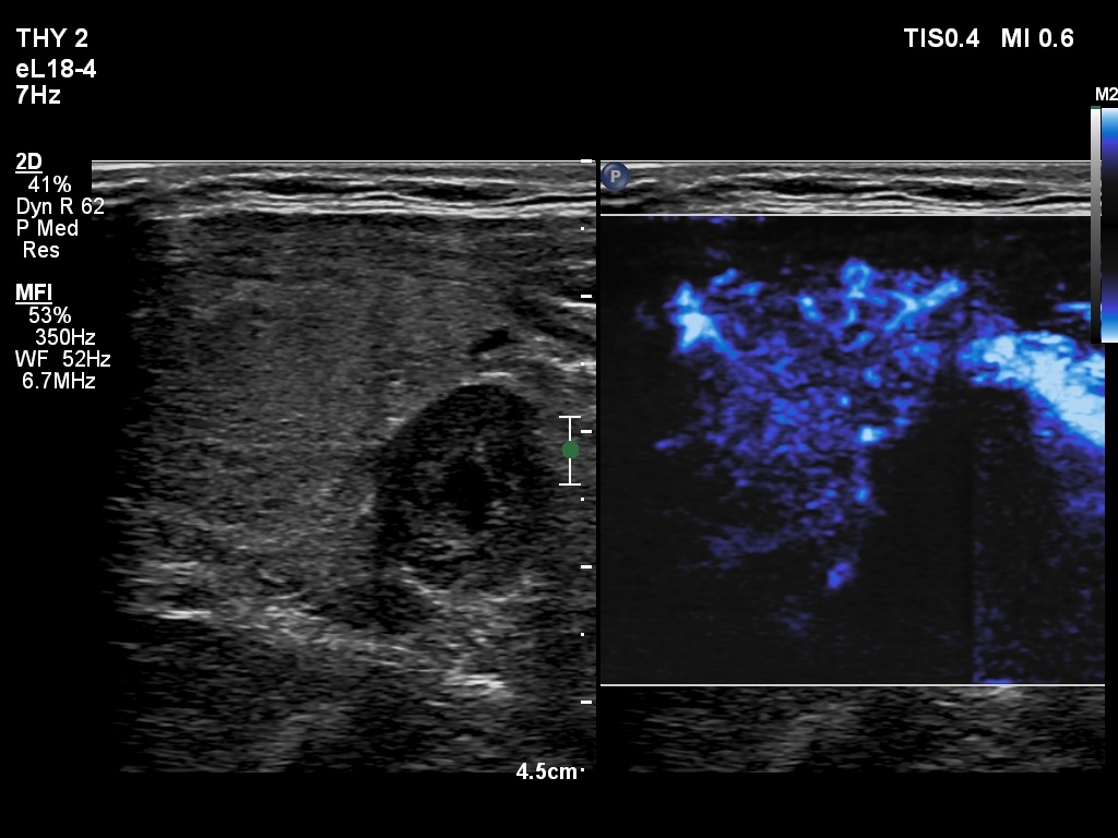 Right lobe, longitudinal scan