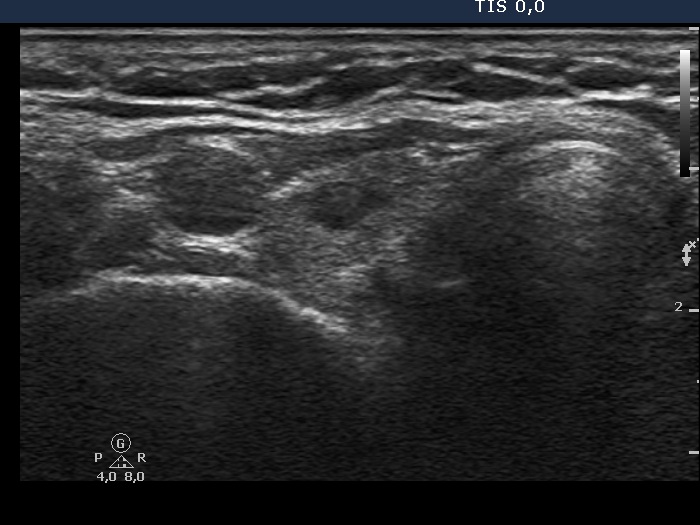 Right lobe, longitudinal scan