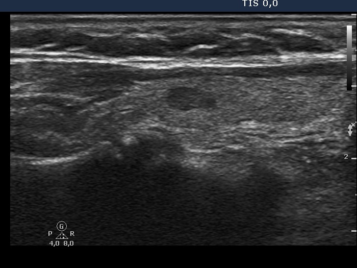 Right lobe, longitudinal scan
