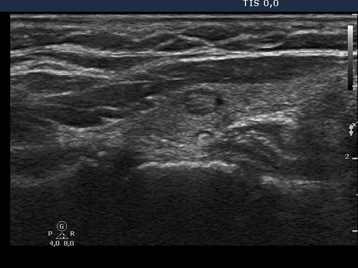 Right lobe, longitudinal scan