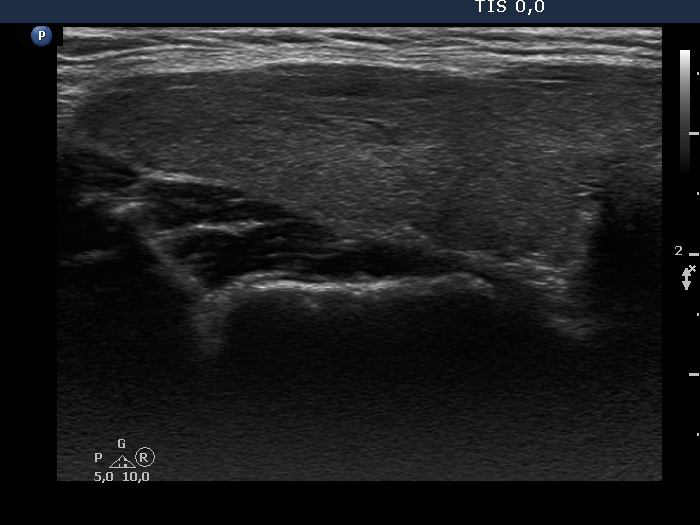 Right lobe, longitudinal scan