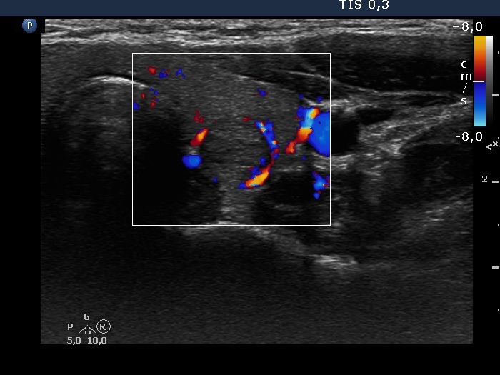 Right lobe, longitudinal scan