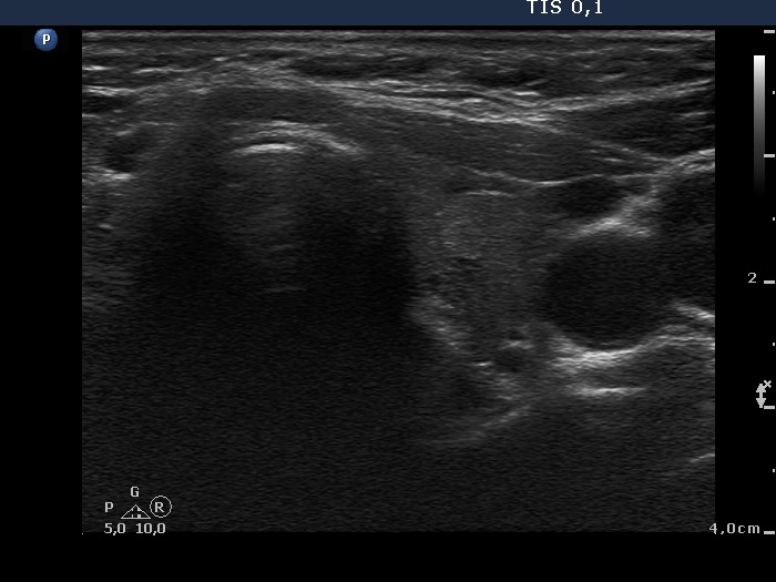 Right lobe, longitudinal scan