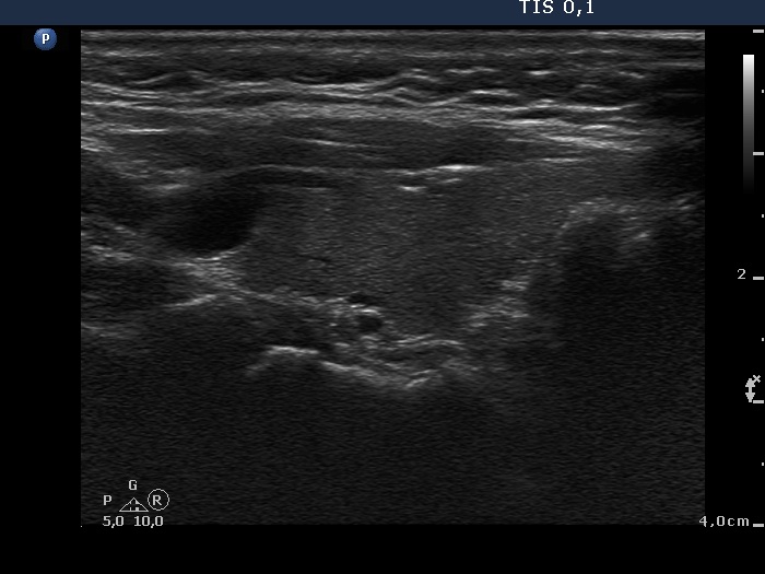Right lobe, longitudinal scan