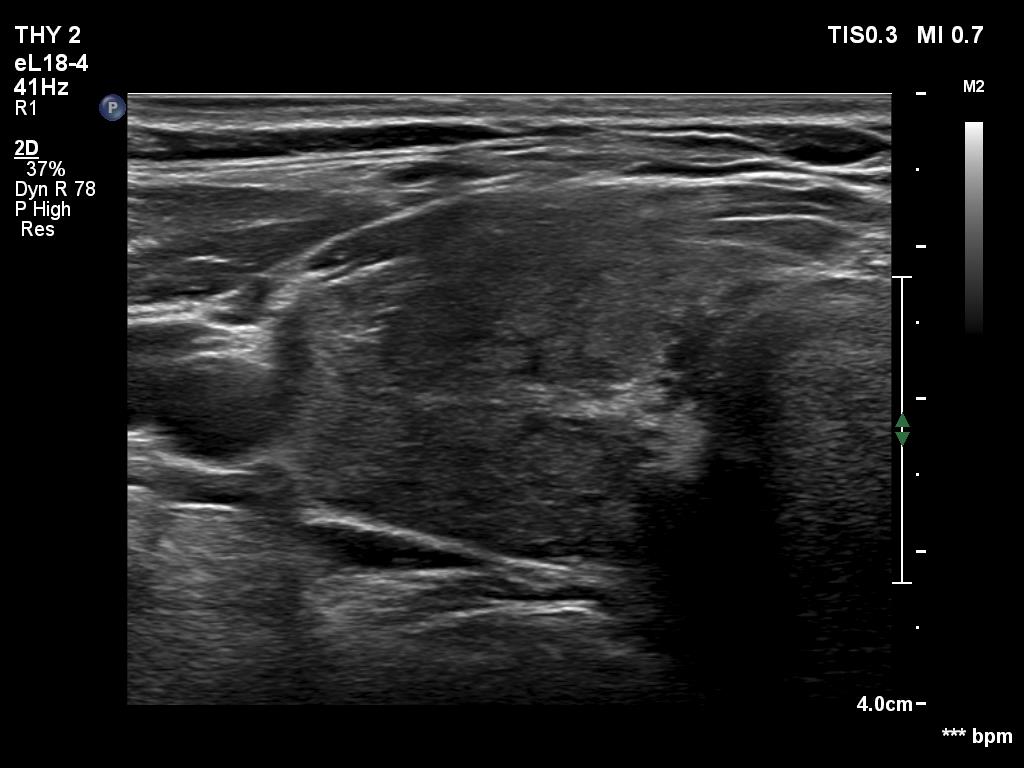 Right lobe, longitudinal scan