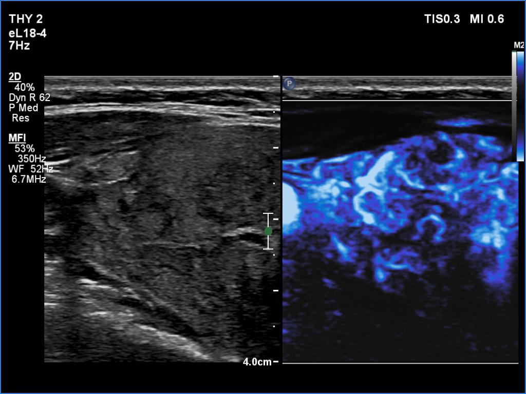 Right lobe, longitudinal scan