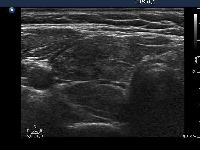 Right lobe, longitudinal scan