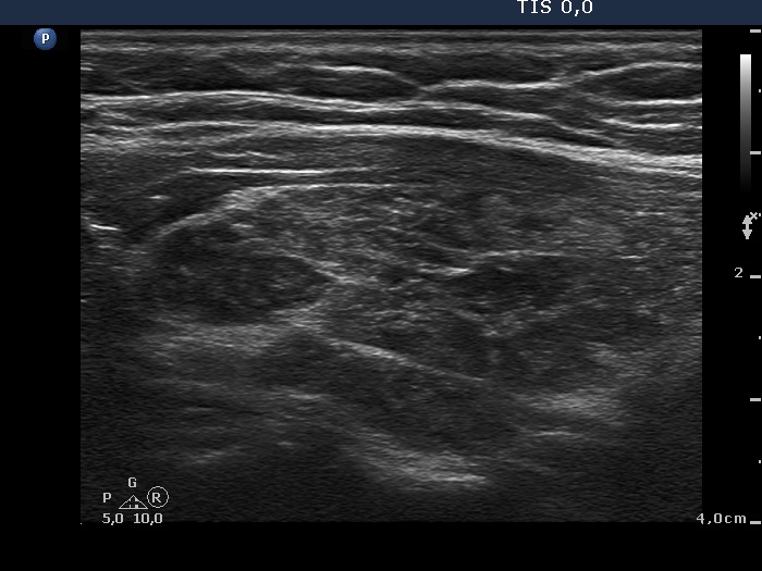 Right lobe, longitudinal scan