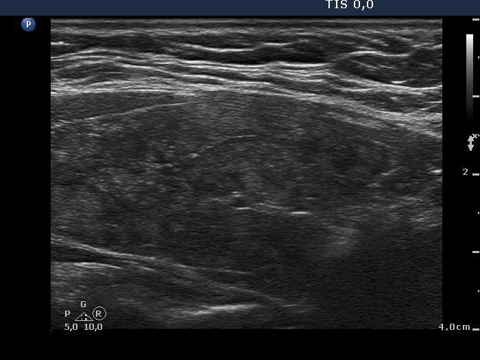 Right lobe, longitudinal scan