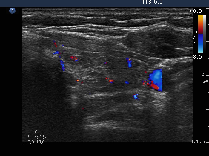 Right lobe, longitudinal scan