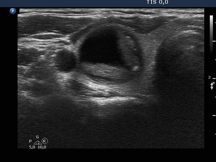 Right lobe, longitudinal scan